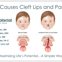 A cleft palate arises when the right and left